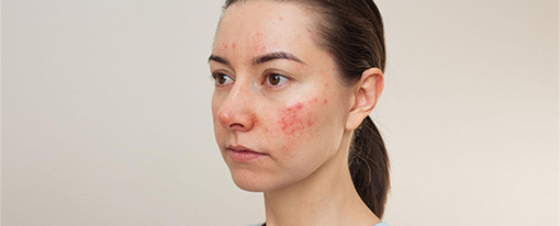 Woman About To Receive Rosacea Treatment Overview