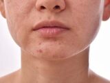 Uneven Skin Tone