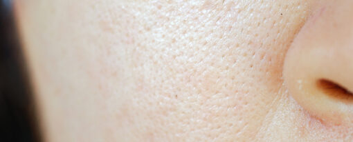 Close Up Of Woman With Large Pores 640x480